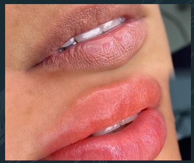 NUTRALIZACION LABIAL - Imagen 3