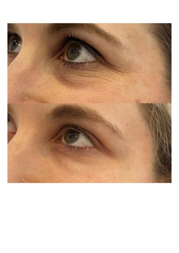 ECPR EYE LIFT