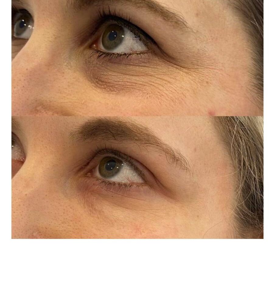 ECPR EYE LIFT