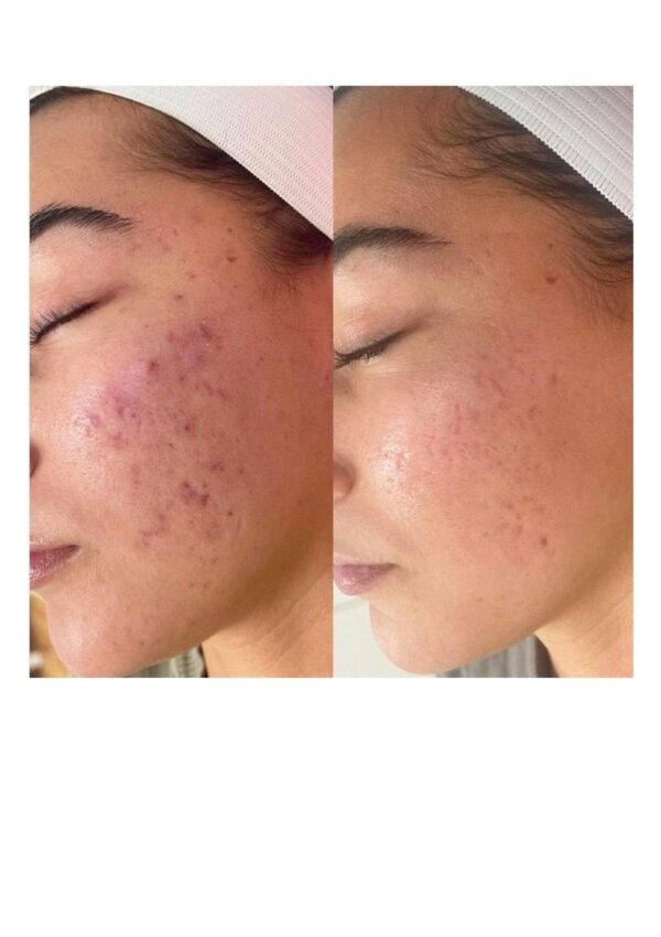 PURIFIYING ACNE