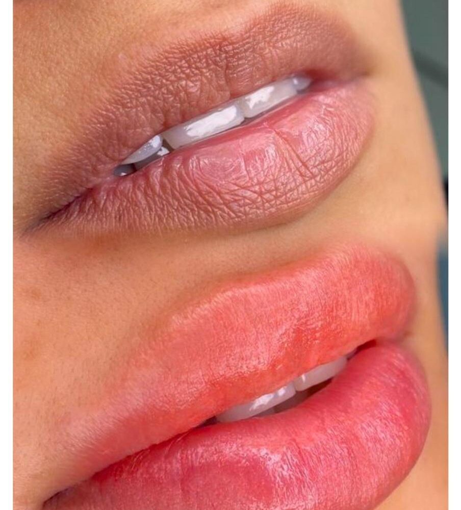 NUTRALIZACION  LABIAL