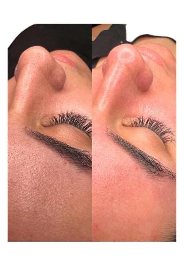 LIMPIEZA FACIAL PROFUNDA