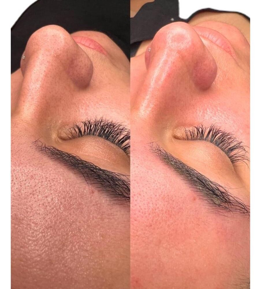 LIMPIEZA FACIAL PROFUNDA